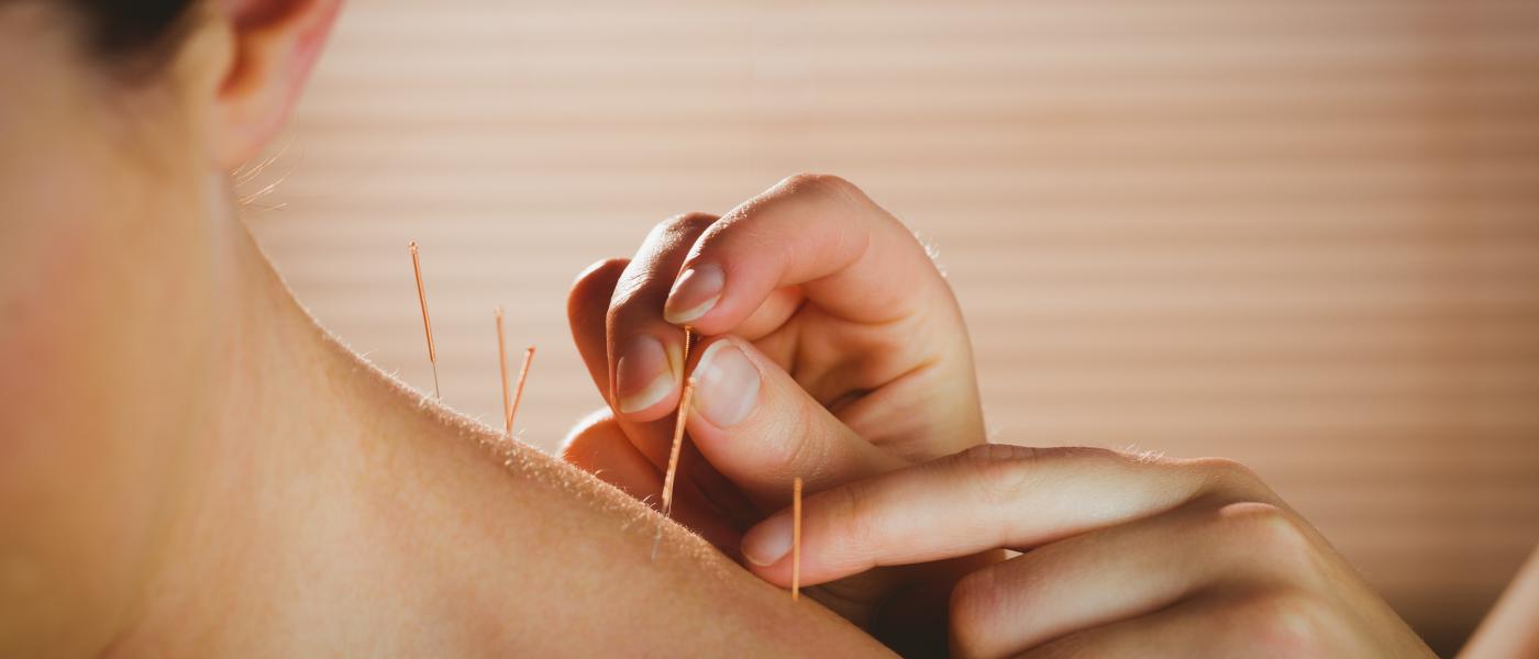 acupuncture